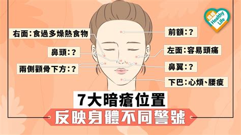 右邊面生暗瘡|【暗瘡位置】不同代表什麼？中醫教如何處理及預防